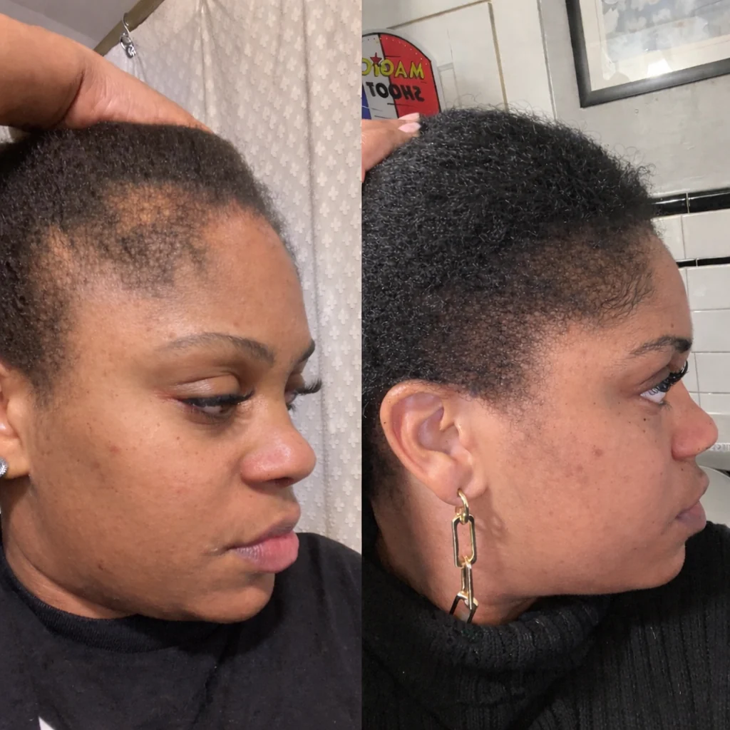 Hormone Hair Revive: 2+1 FREE (one time purchase) - Image 3